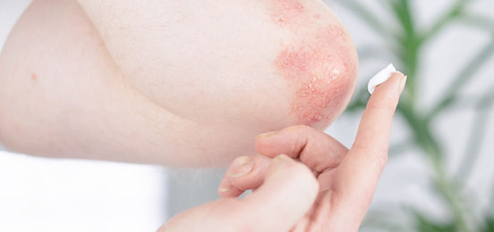 Taking care of your skin with psoriasis