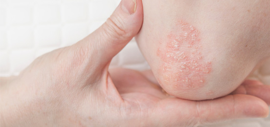 What is psoriasis?